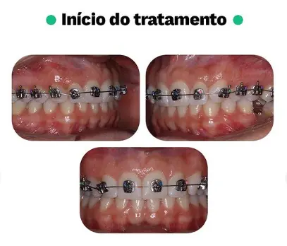 Caso Clínico de apinhamento e inclinação palatina de dentes posteriores
