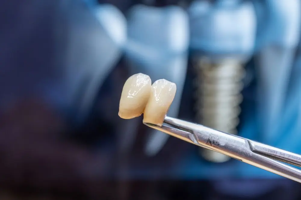 Tipos de materiais para coroas dentárias