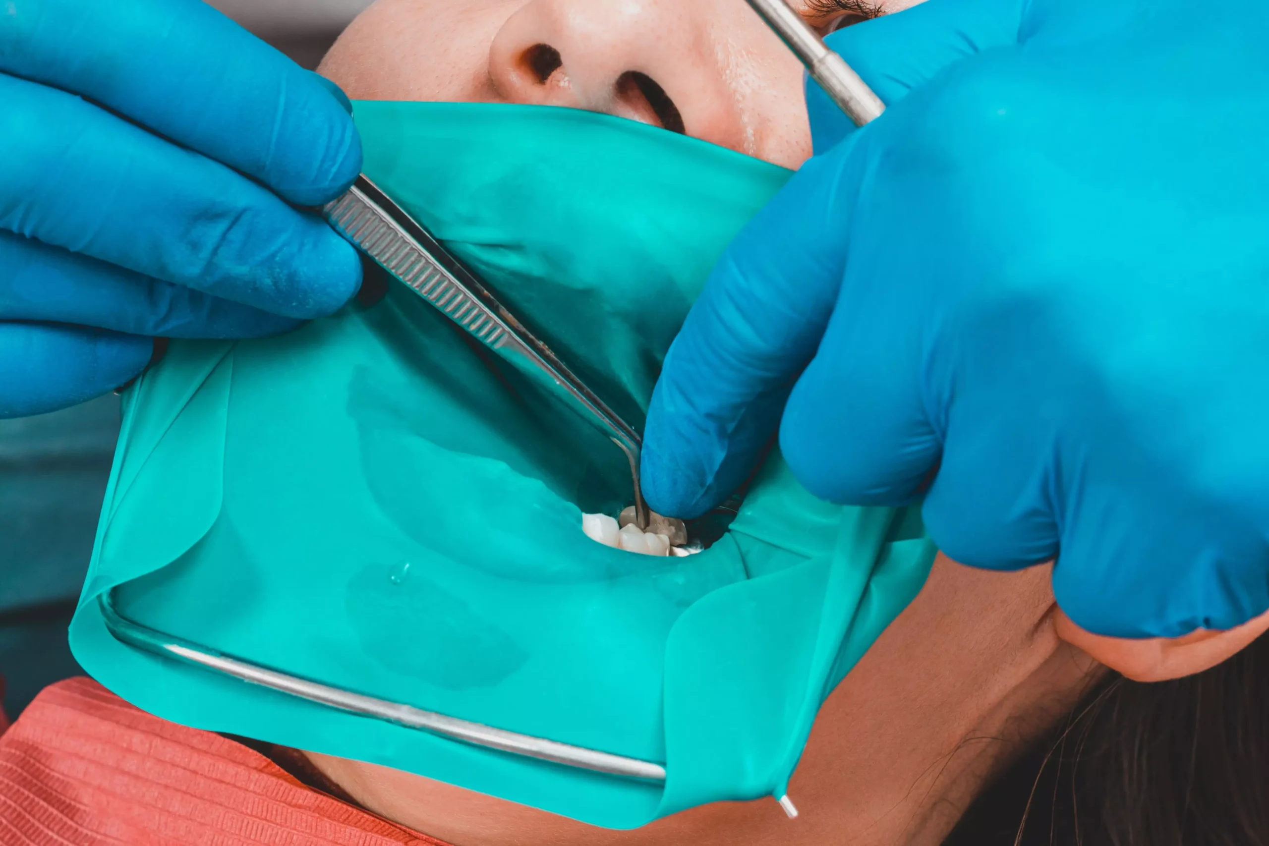 Tipos de grampos odontológicos e seus usos 