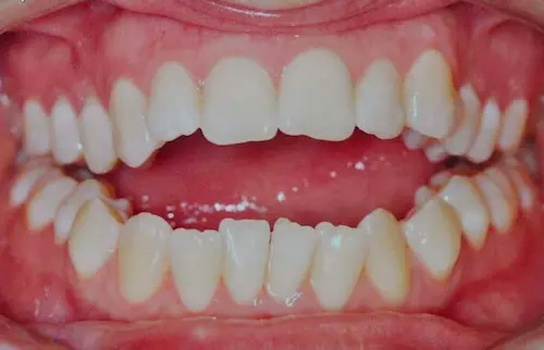 mordida aberta bilateral