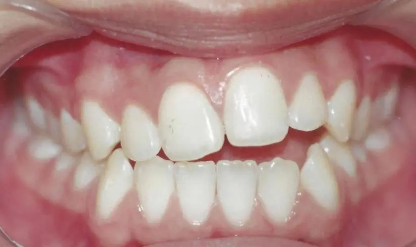 mordida aberta unilateral