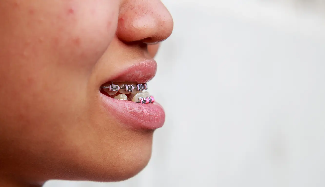 Indicações da cirurgia ortognática