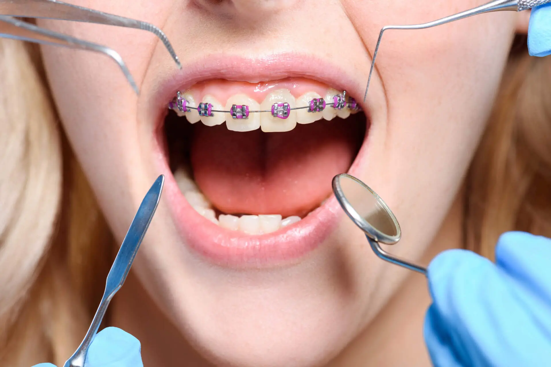 Diferenças entre aparelho ortopédico e ortodôntico 